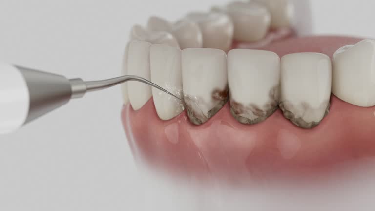 Trusted Wisdom Tooth Removal service in Black Hammock, FL - Dentist Open Now